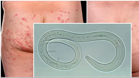 Cuplul care s-a trezit cu o iritatie pe posterior in timpul vacantei. Au ajuns de urgenta la spital. Medicii au fost socati sa descopere ce au in PIELE