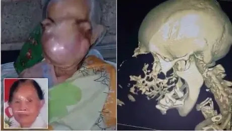 Medicii au crezut ca are sinuzita, insa ce se intampla in nasul femeii e INFIORATOR! Oasele craniului s-au rupt si a ajuns sa arate ca un monstru