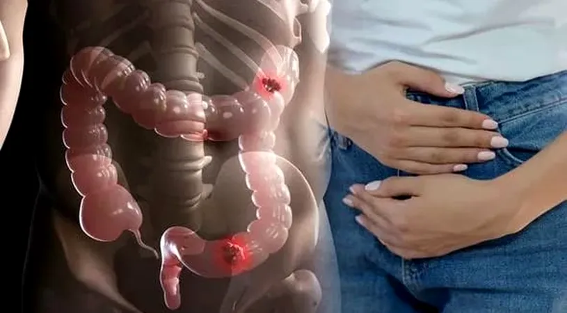 Atenție, nu ignorați! Care sunt primele simptome ale cancerului de colon și cum poate fi depistat
